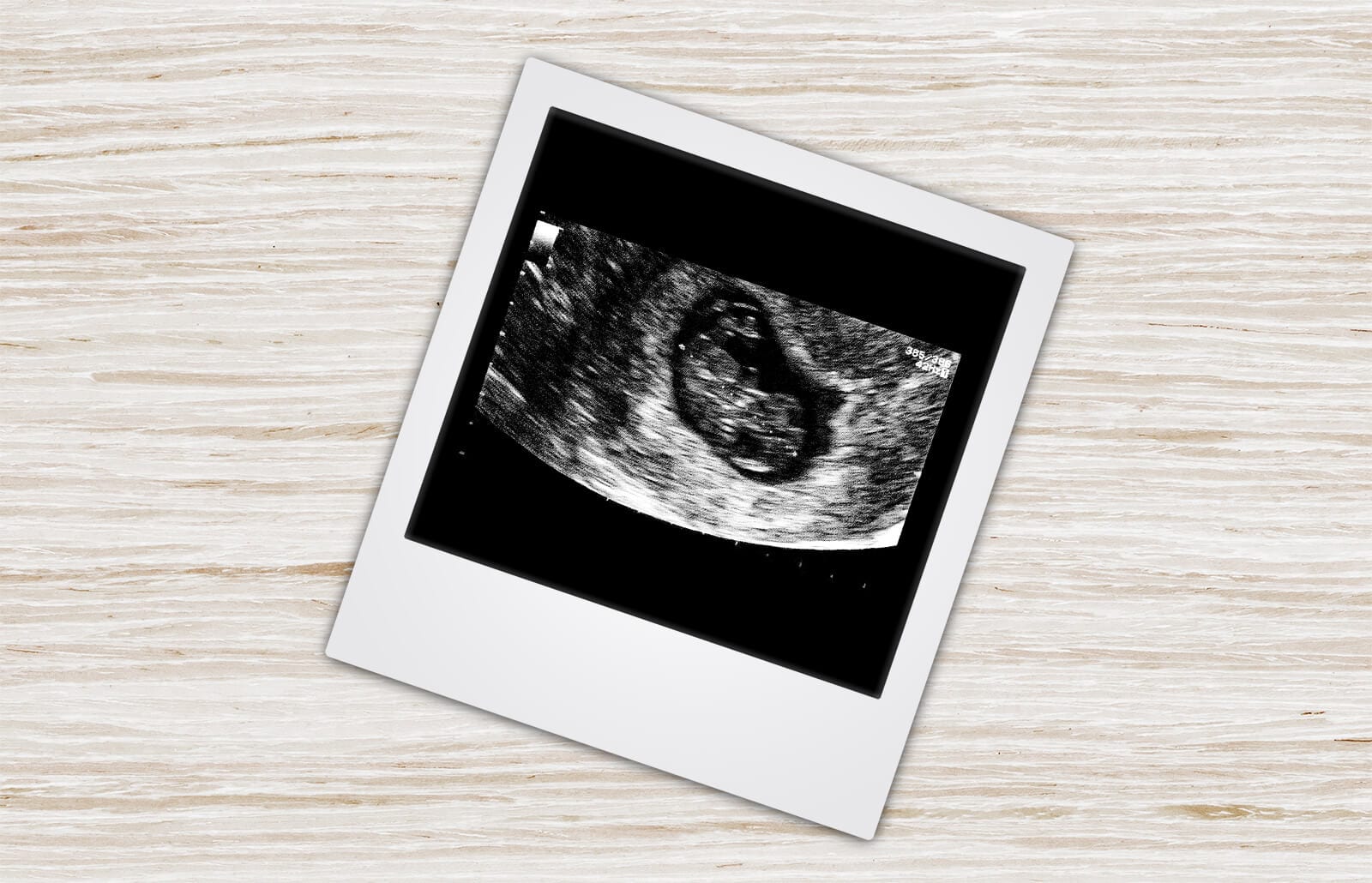 Интересные снимки УЗИ С беременности